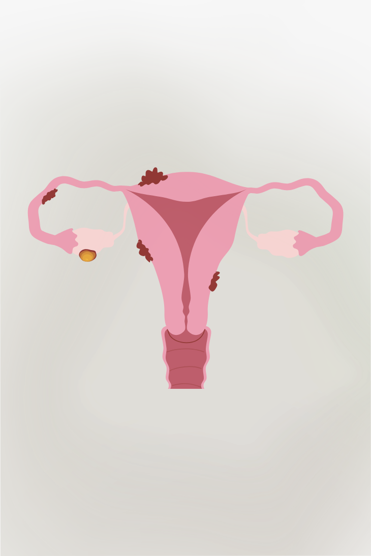Pjur IG KW10 Story Endometriose Awareness Month 730 x 1094 px